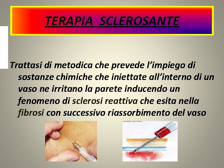 TERAPIA SCLEROSANTE Trattasi di metodica che prevede l’impiego di sostanze chimiche iniettate all’interno di