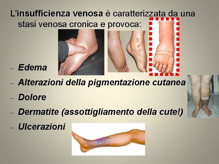 L'insufficienza venosa è caratterizzata da una stasi venosa cronica e provoca: Edema Alterazioni della