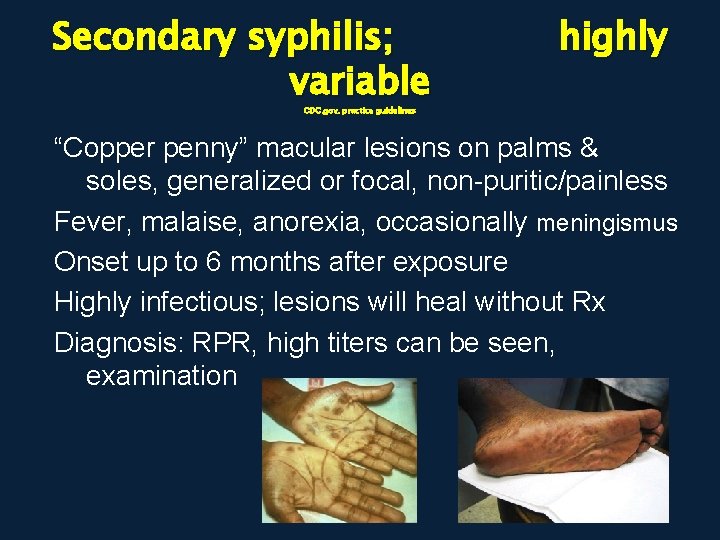 Secondary syphilis; variable highly CDC. gov, practice guidelines “Copper penny” macular lesions on palms