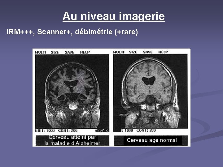 Au niveau imagerie IRM+++, Scanner+, débimétrie (+rare) 