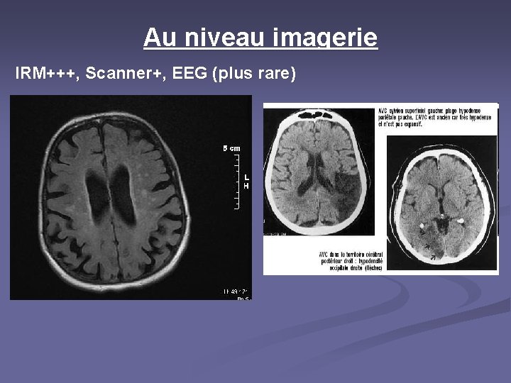 Au niveau imagerie IRM+++, Scanner+, EEG (plus rare) 