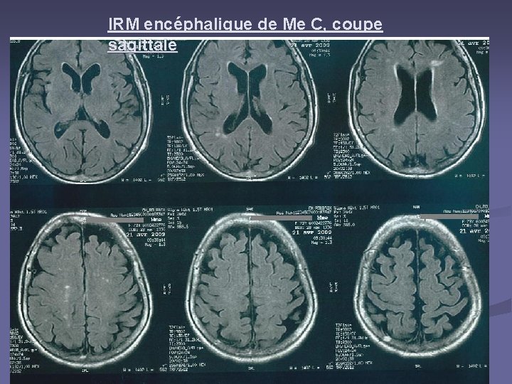 IRM encéphalique de Me C, coupe sagittale 