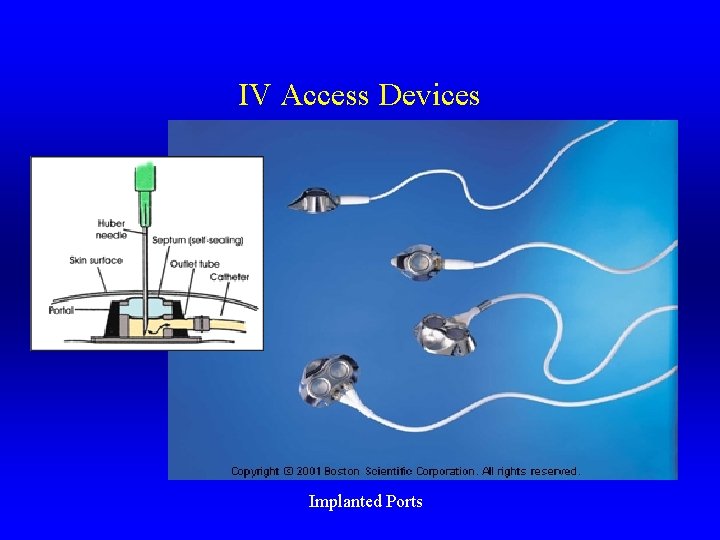 IV Access Devices Implanted Ports 