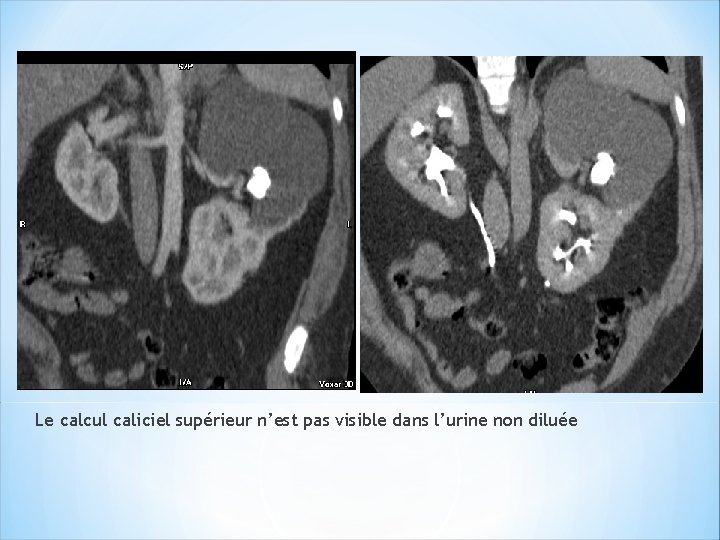Le calcul caliciel supérieur n’est pas visible dans l’urine non diluée 