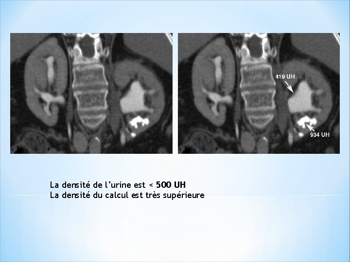 La densité de l’urine est < 500 UH La densité du calcul est très