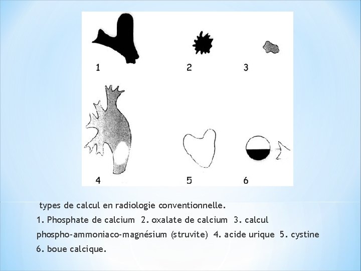 types de calcul en radiologie conventionnelle. 1. Phosphate de calcium 2. oxalate de calcium