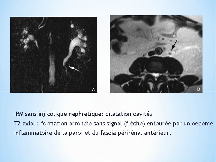 IRM sans inj colique nephretique: dilatation cavités T 2 axial : formation arrondie sans