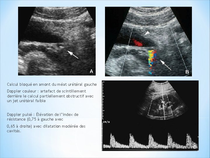 Calcul bloqué en amont du méat urétéral gauche Doppler couleur : artefact de scintillement
