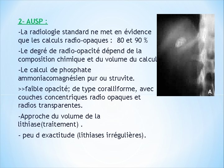 2 - AUSP : -La radiologie standard ne met en évidence que les calculs