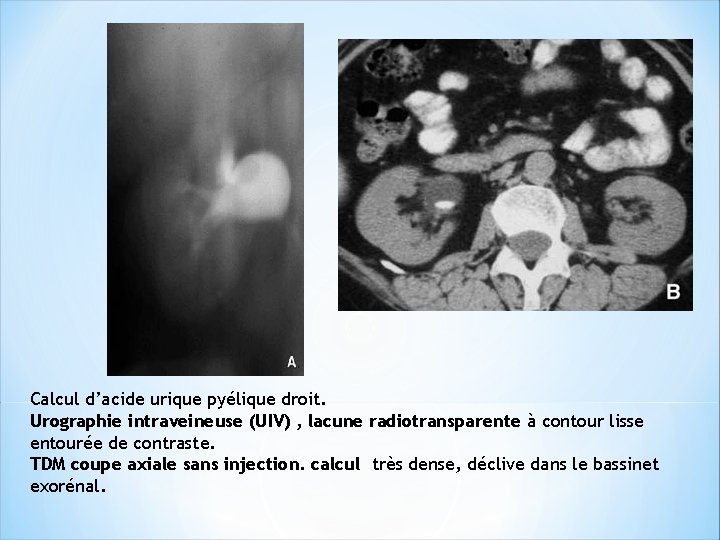 Calcul d’acide urique pyélique droit. Urographie intraveineuse (UIV) , lacune radiotransparente à contour lisse