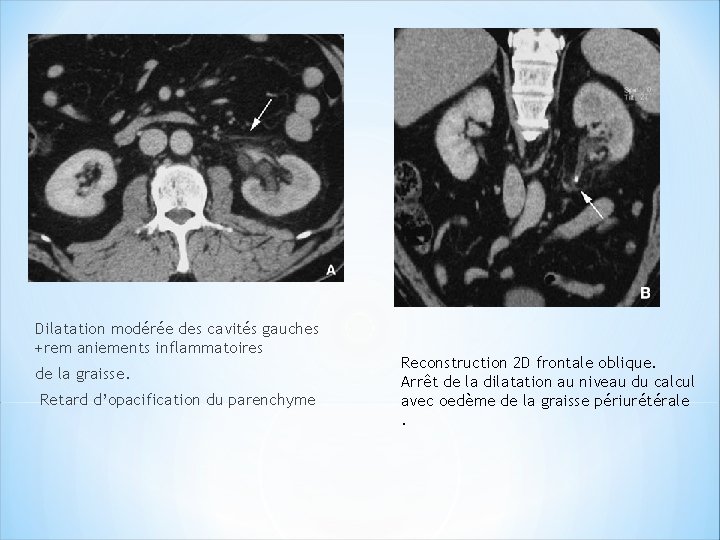 Dilatation modérée des cavités gauches +rem aniements inflammatoires de la graisse. Retard d’opacification du