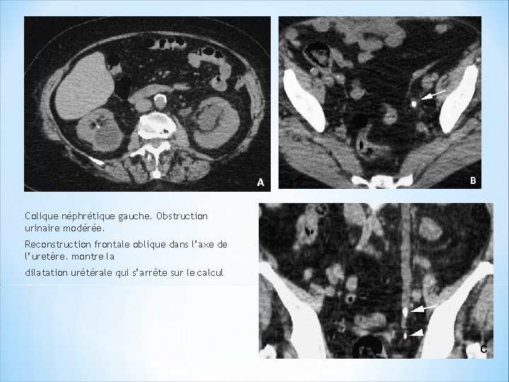 Colique néphrétique gauche. Obstruction urinaire modérée. Reconstruction frontale oblique dans l’axe de l’uretère. montre