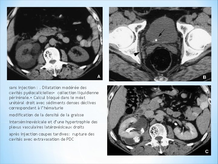 sans injection : . Dilatation modérée des cavités pyélocalicielles+ collection liquidienne périrénale. + Calcul