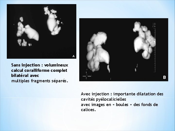 Sans injection : volumineux calcul coralliforme complet bilatéral avec multiples fragments séparés. Avec injection