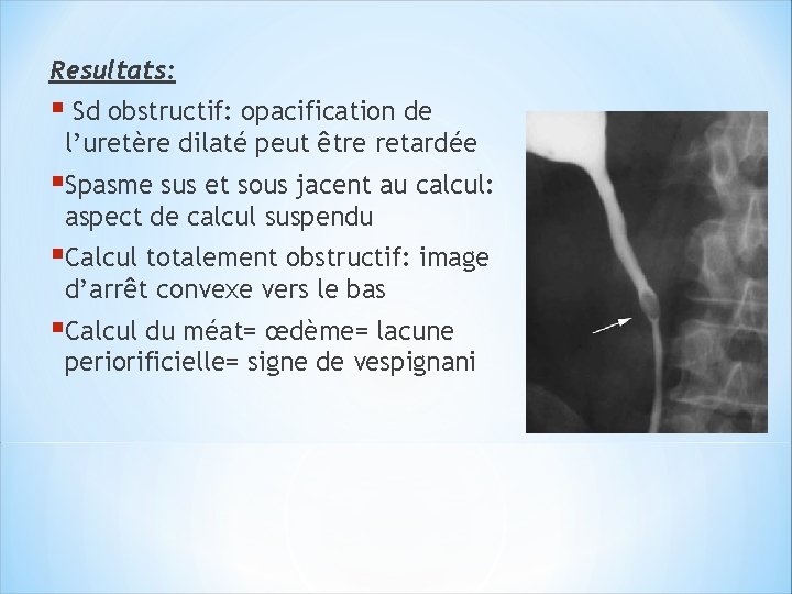 Resultats: § Sd obstructif: opacification de l’uretère dilaté peut être retardée §Spasme sus et
