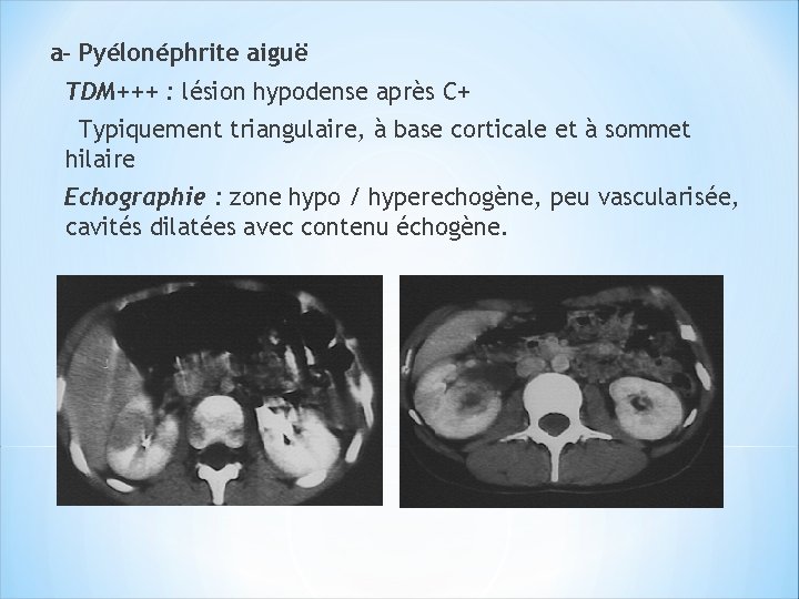 a- Pyélonéphrite aiguë TDM+++ : lésion hypodense après C+ Typiquement triangulaire, à base corticale