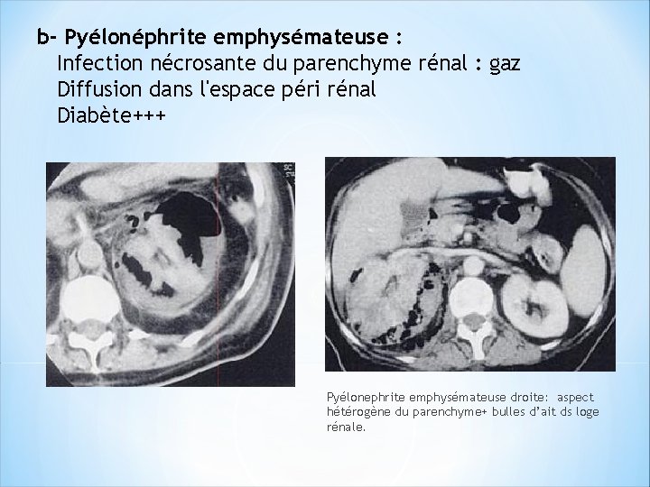 b- Pyélonéphrite emphysémateuse : Infection nécrosante du parenchyme rénal : gaz Diffusion dans l'espace