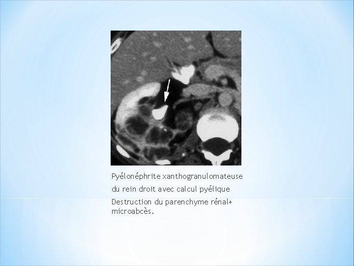 Pyélonéphrite xanthogranulomateuse du rein droit avec calcul pyélique Destruction du parenchyme rénal+ microabcès. 