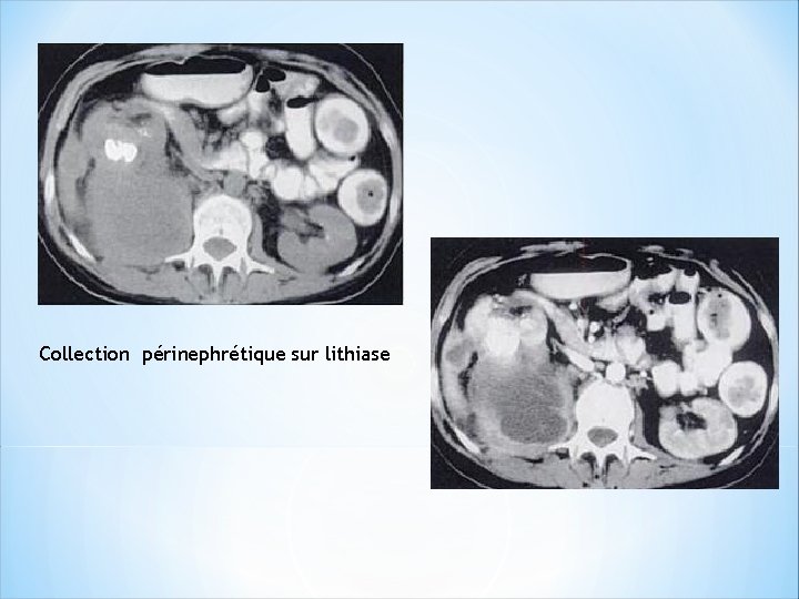 Collection périnephrétique sur lithiase 