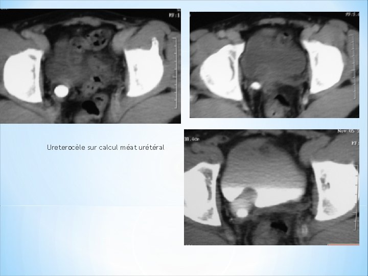 Ureterocèle sur calcul méat urétéral 