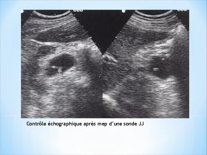 Contrôle échographique après mep d’une sonde JJ 
