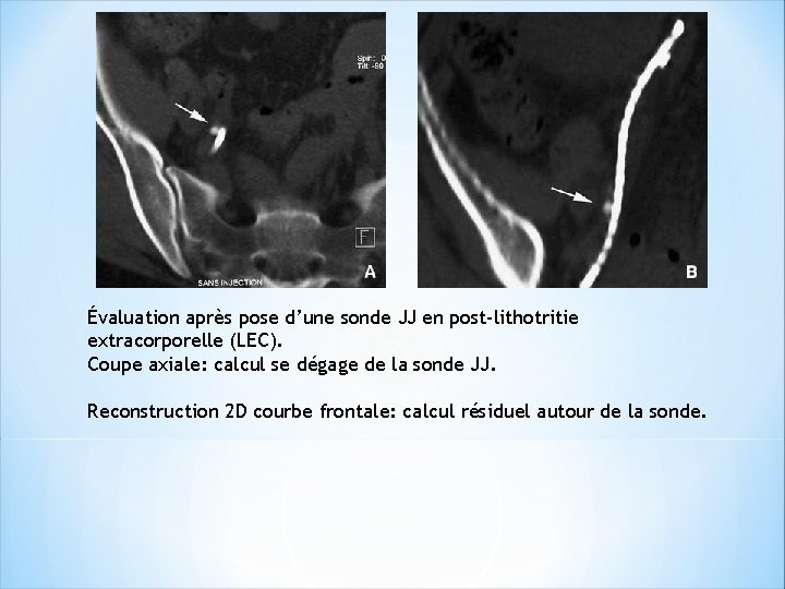 Évaluation après pose d’une sonde JJ en post-lithotritie extracorporelle (LEC). Coupe axiale: calcul se