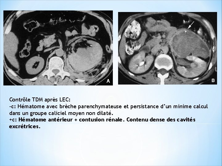 Contrôle TDM après LEC: -c: Hématome avec brèche parenchymateuse et persistance d’un minime calcul