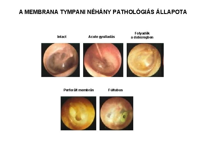 A MEMBRANA TYMPANI NÉHÁNY PATHOLÓGIÁS ÁLLAPOTA Intact Acute gyulladás Perforált membrán Fültubus Folyadék a