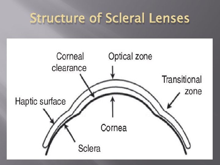 Structure of Scleral Lenses 