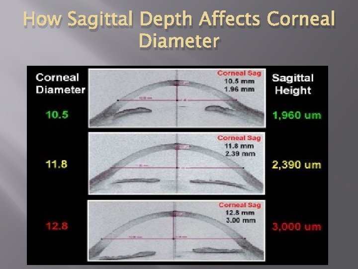 How Sagittal Depth Affects Corneal Diameter 