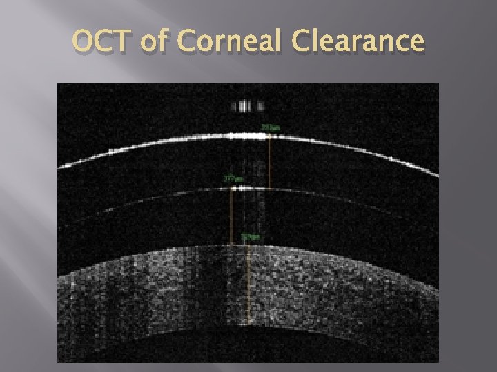 OCT of Corneal Clearance 