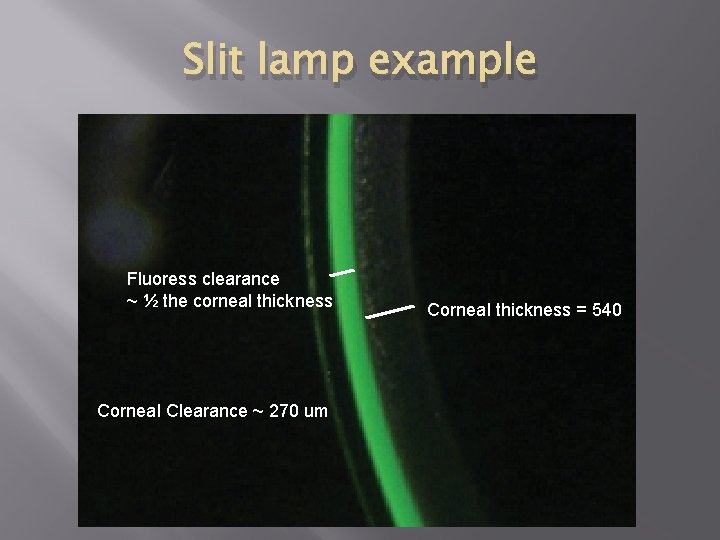 Slit lamp example Fluoress clearance ~ ½ the corneal thickness Corneal Clearance ~ 270