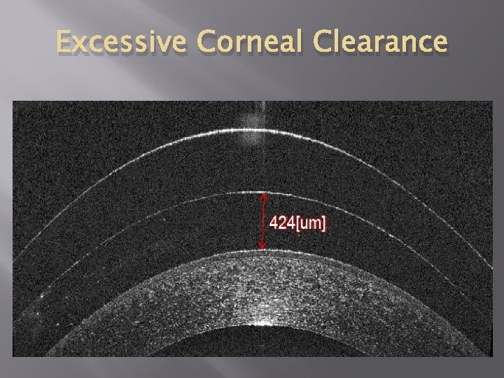 Excessive Corneal Clearance 