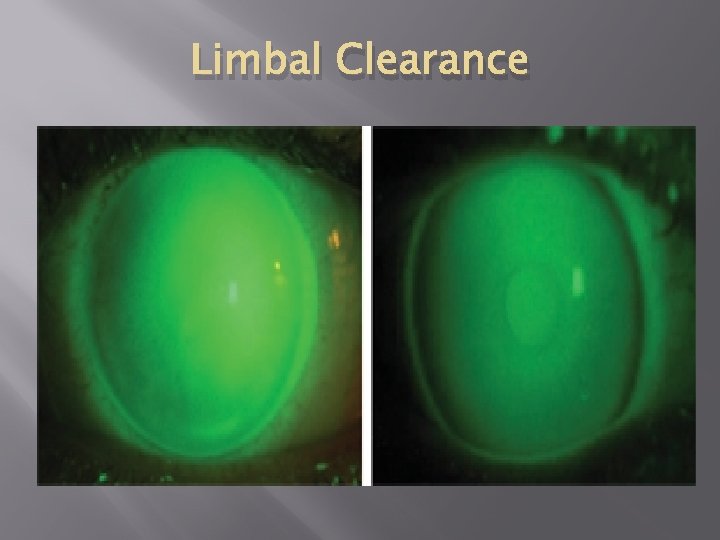 Limbal Clearance 