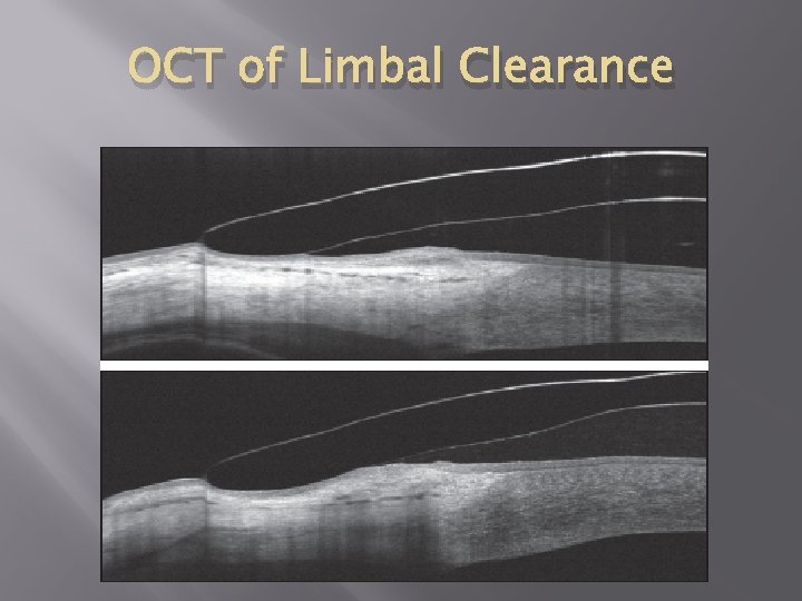 OCT of Limbal Clearance 