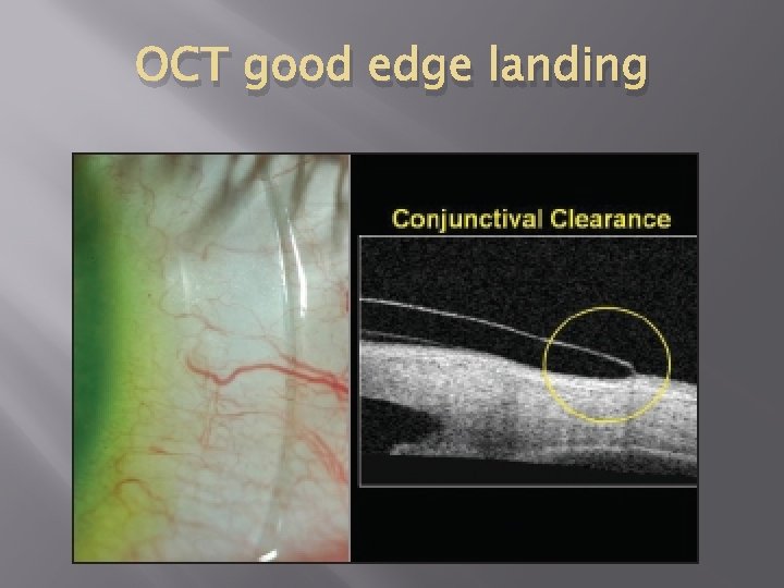 OCT good edge landing 