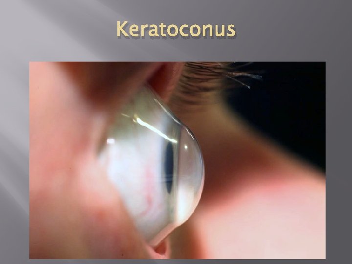 Keratoconus 