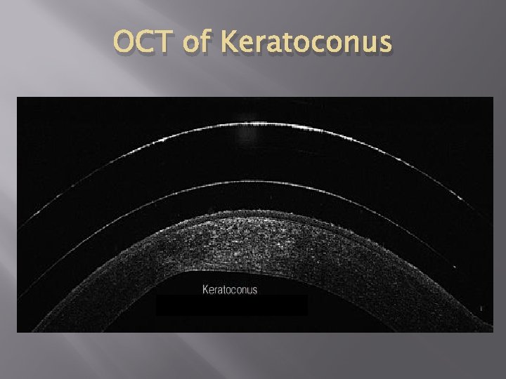 OCT of Keratoconus Keratocnusoooooo 