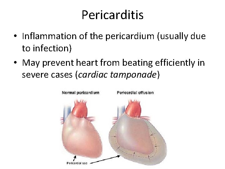 Pericarditis • Inflammation of the pericardium (usually due to infection) • May prevent heart