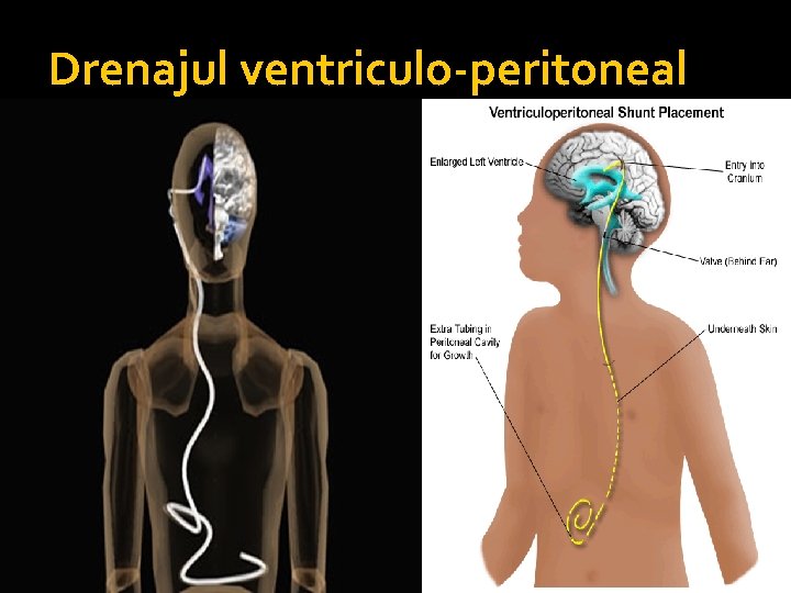 Drenajul ventriculo-peritoneal • se măsoară presiunea intracraniană, recoltare LCR-ex biochimic • conectarea valvei în