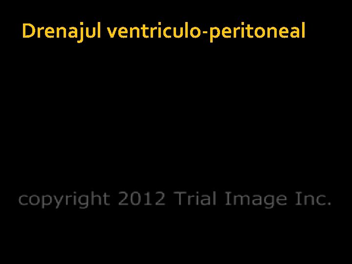 Drenajul ventriculo-peritoneal 