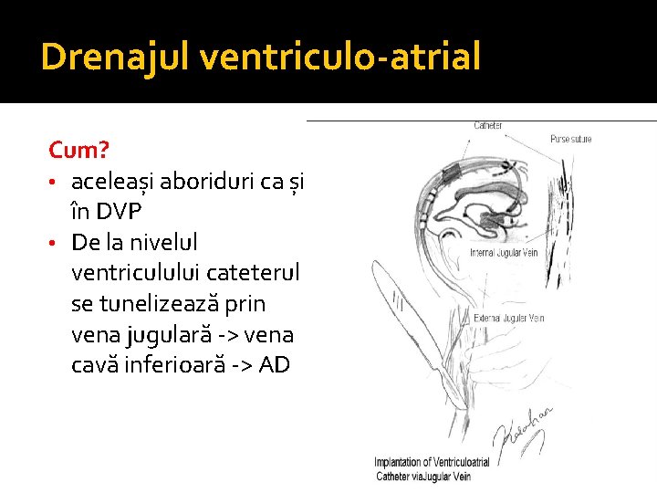 Drenajul ventriculo-atrial Cum? • aceleași aboriduri ca și în DVP • De la nivelul