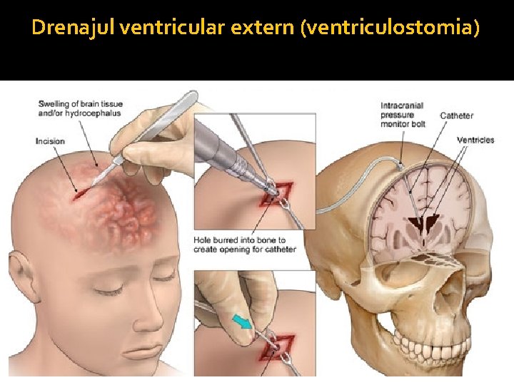 Drenajul ventricular extern (ventriculostomia) Cum? • de obicei –ventriculul latera de pe partea nedominantă(dreaptă)