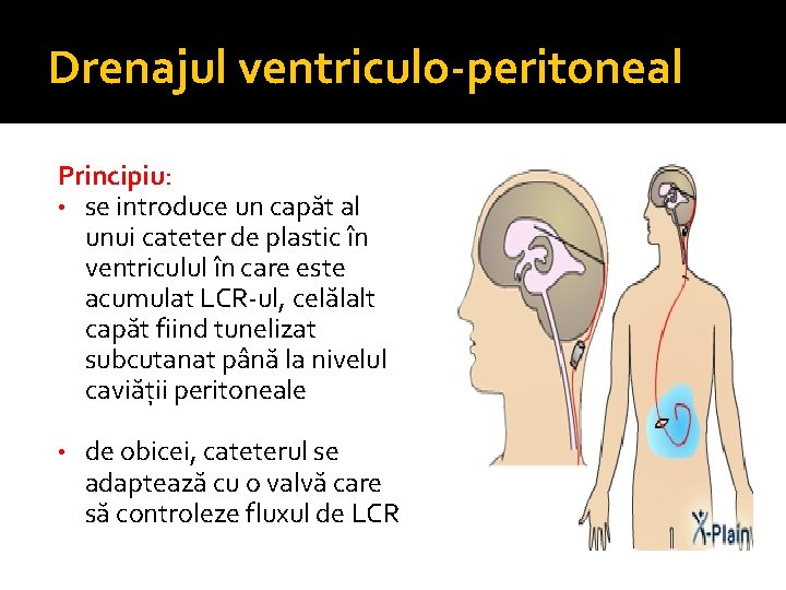 Drenajul ventriculo-peritoneal Principiu: • se introduce un capăt al unui cateter de plastic în