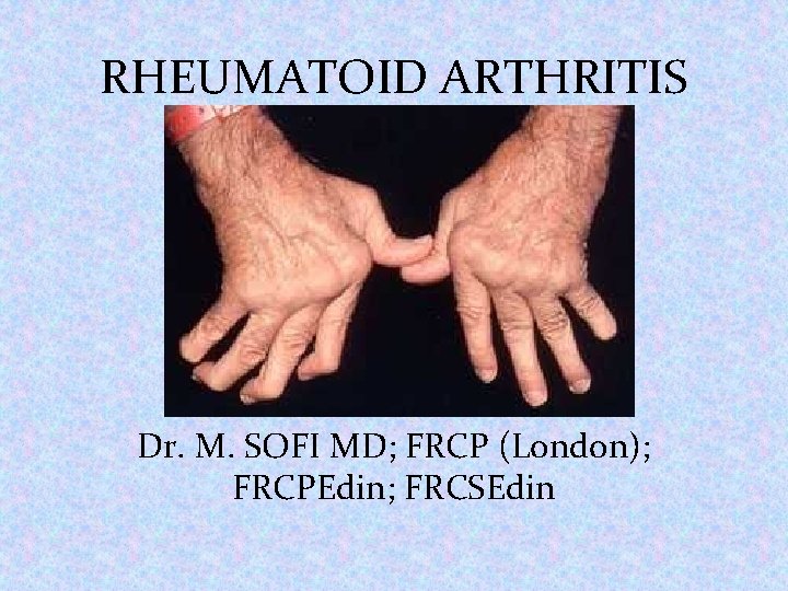 RHEUMATOID ARTHRITIS Dr. M. SOFI MD; FRCP (London); FRCPEdin; FRCSEdin 