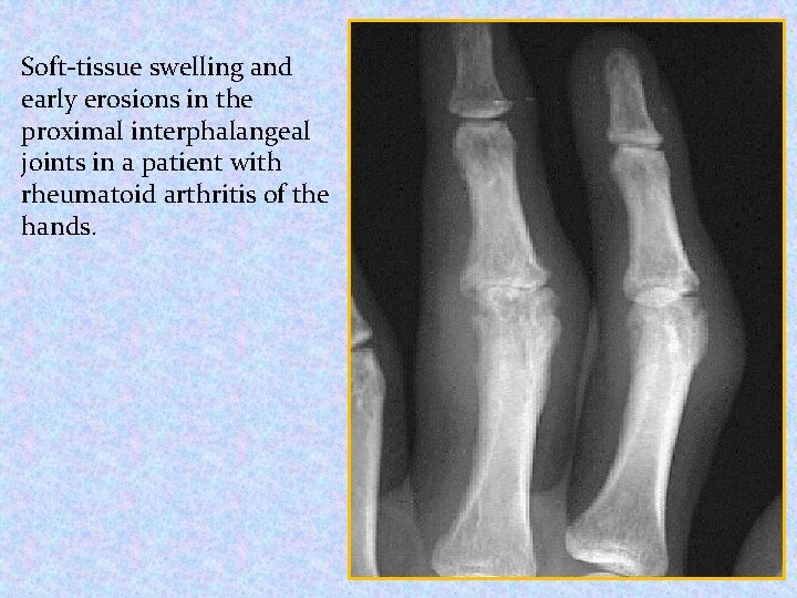 Soft-tissue swelling and early erosions in the proximal interphalangeal joints in a patient with