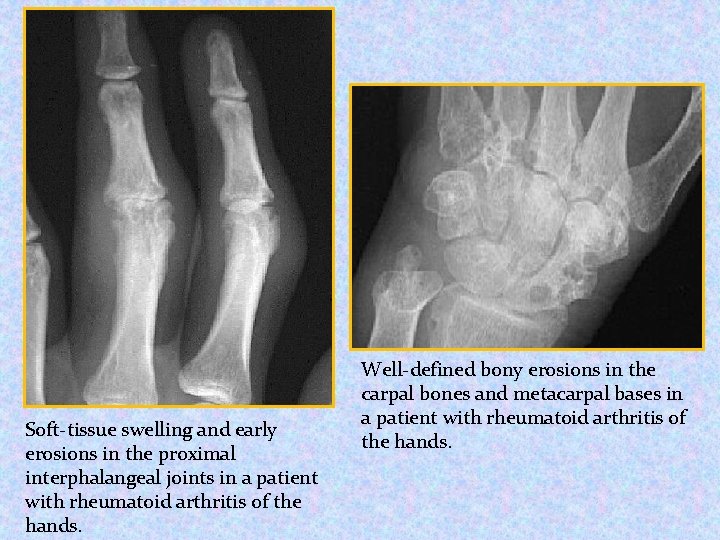Soft-tissue swelling and early erosions in the proximal interphalangeal joints in a patient with