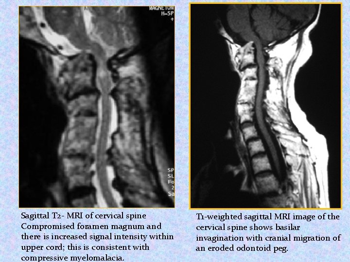 Sagittal T 2 - MRI of cervical spine Compromised foramen magnum and there is