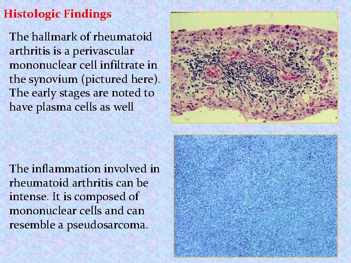 Histologic Findings The hallmark of rheumatoid arthritis is a perivascular mononuclear cell infiltrate in