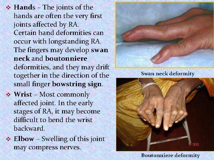 Hands – The joints of the hands are often the very first joints affected